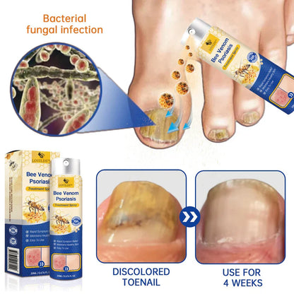 Spray contre le psoriasis LOVILDS™ PsoriaHeal (Pack 2 pièce)