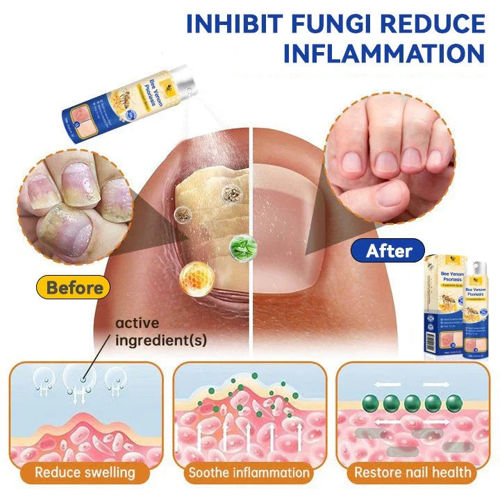 Spray contre le psoriasis LOVILDS™ PsoriaHeal (Pack 2 pièce)