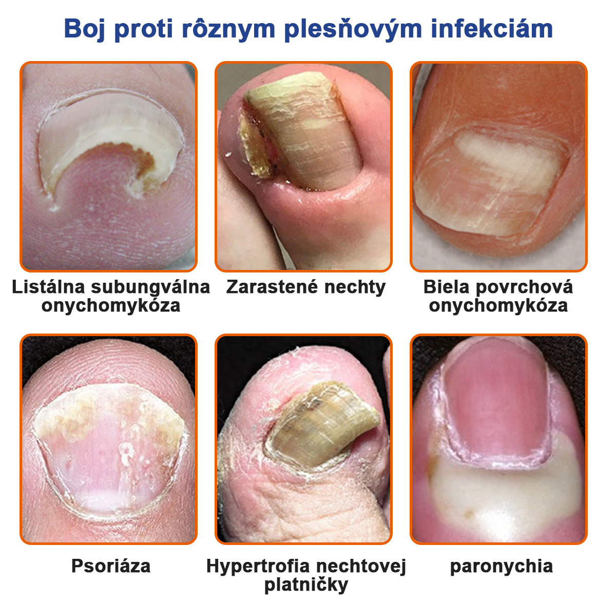 🐝Furzero™ Včelí jed na plesne na nechtoch: kompletné riešenie plesní na nechtoch 🌟👣👣👣