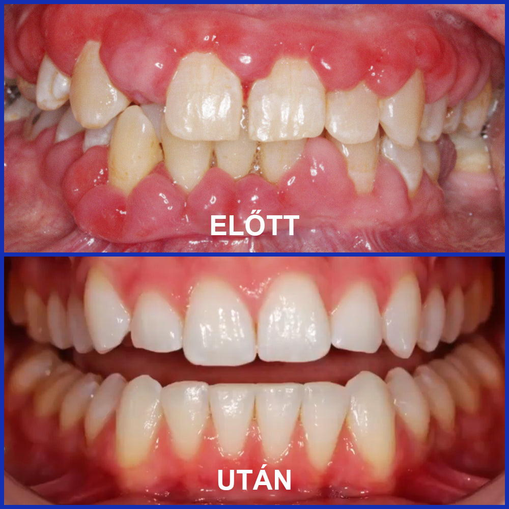 🇭🇺 Furzero® 𝑭𝒐𝒄𝒖𝒔𝒔𝒎𝒊𝒍𝒆 – Méhméreges szájápoló por 🦷🦷