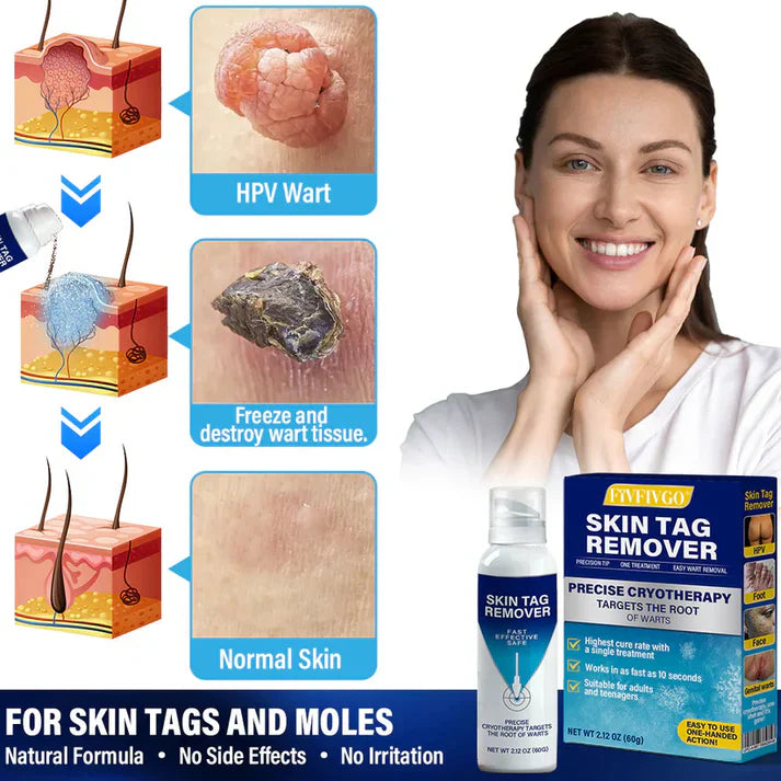 Spray de tratamento criogênico