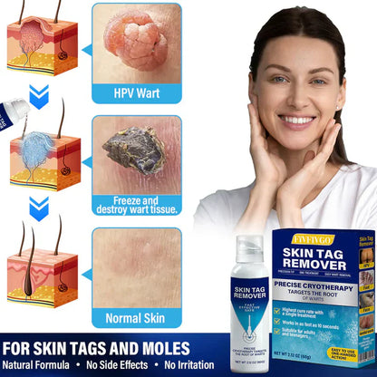 Spray de tratamento criogênico