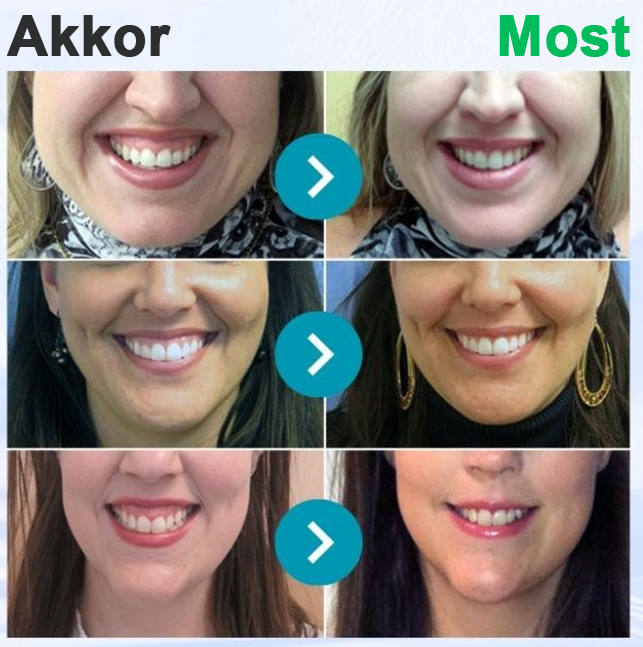 🇭🇺 Furzero® 𝑭𝒐𝒄𝒖𝒔𝒔𝒎𝒊𝒍𝒆 – Méhméreges szájápoló por 🦷🦷