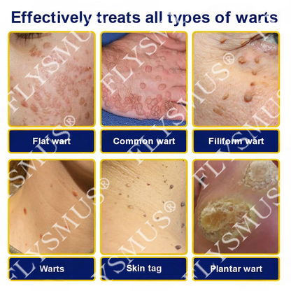 FLYSMUS® SKIN TAG CRYO TREATMENT SPRAY ACE