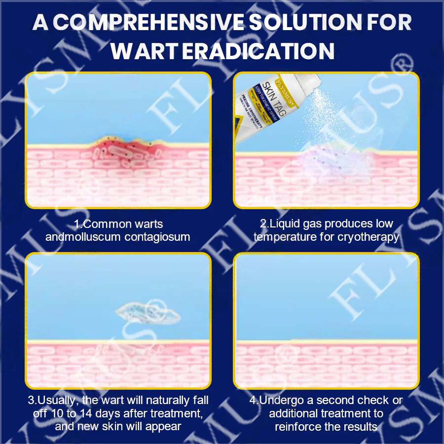 FLYSMUS® SKIN TAG CRYO TREATMENT SPRAY ACE