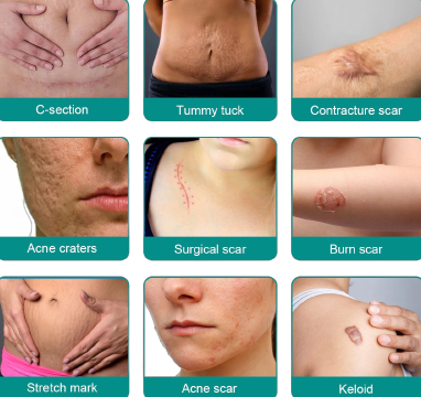 Fivfivgo™ Advanced Scar Removal Spray